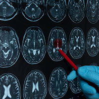Gloved hand pointing at series of radiologic images of the brain